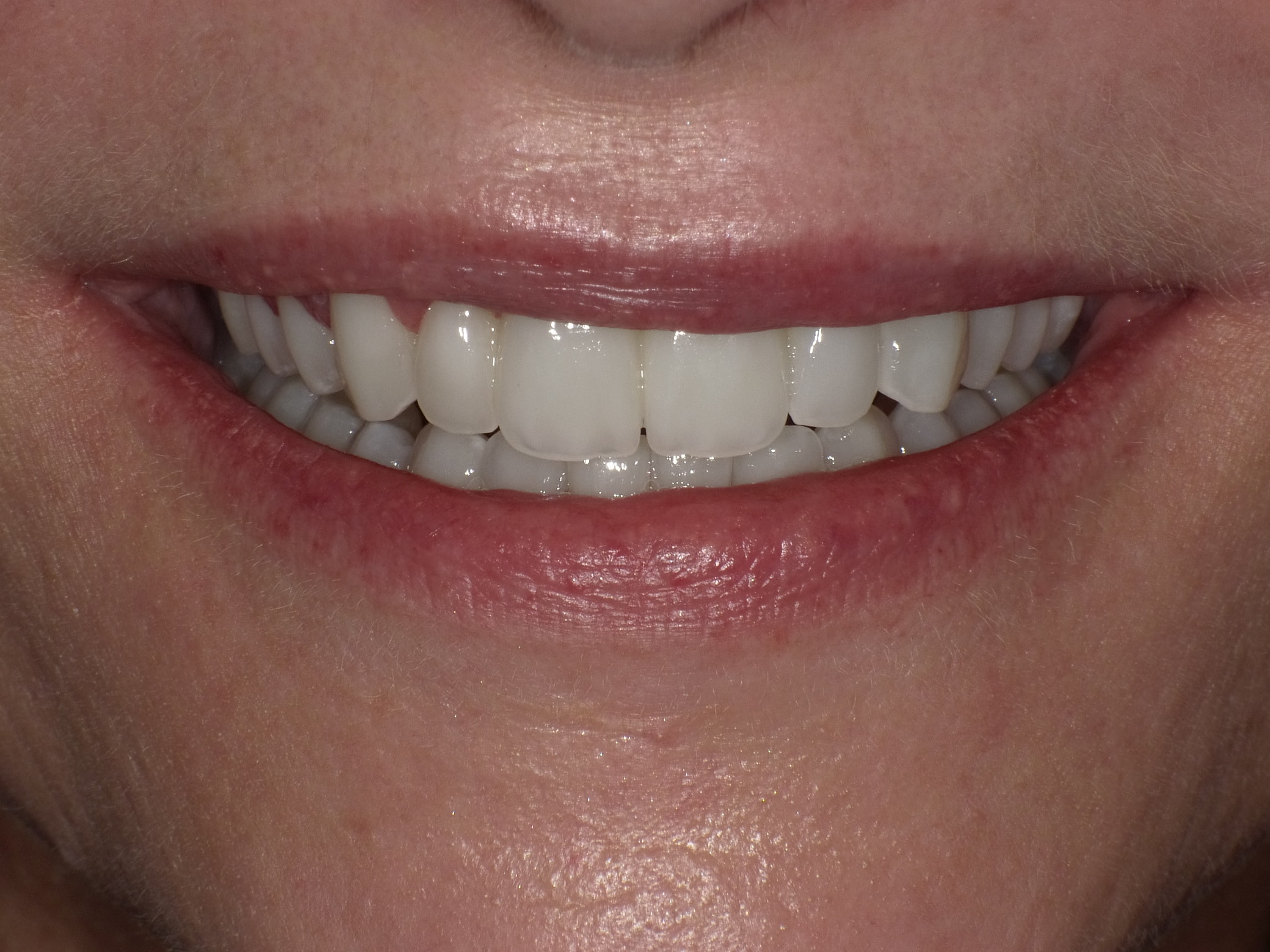Komplette Veränderung mit vollkeramischen Kronen und Veneers in nur 2 Langzeitterminen; auch hier nachher ganz anderes Auftreten der Patientin, die ihre Zähne jetzt gerne zeigt und wieder gerne lacht